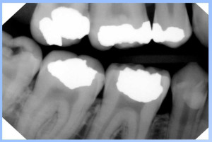 Quickray Sensor Bitewing