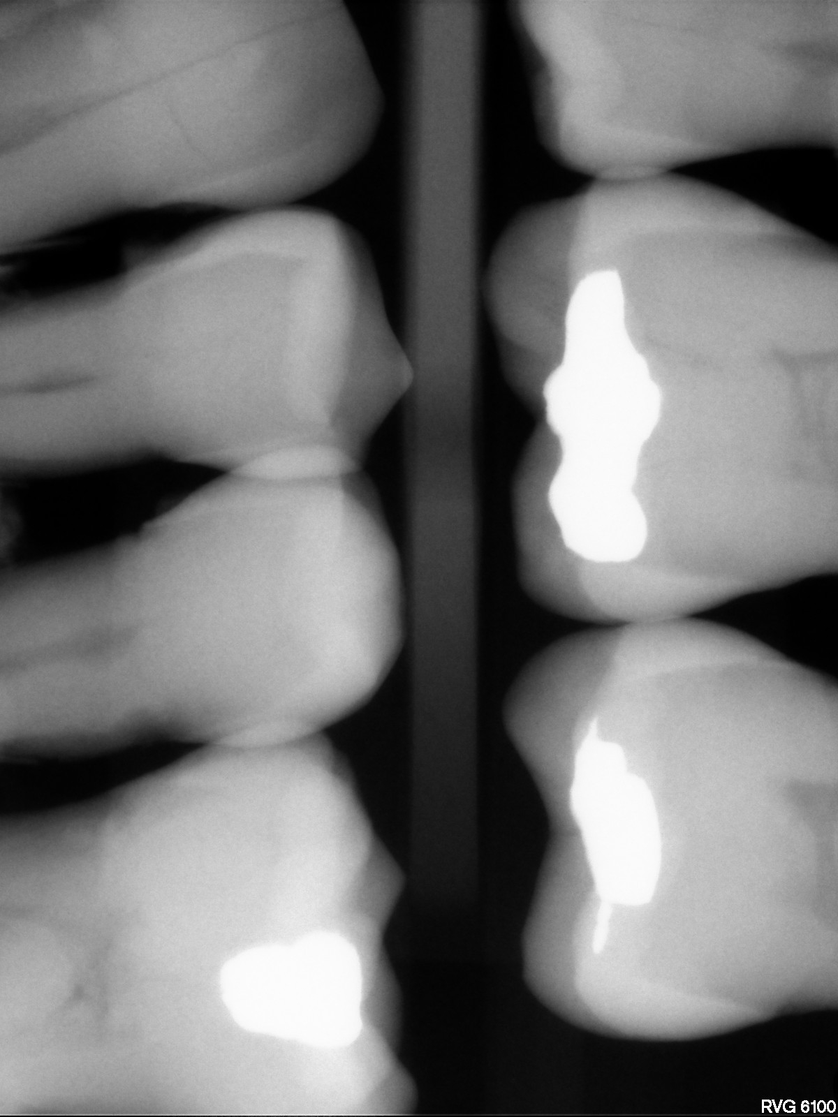 Pre-Owned Kodak RVG 6100 Size 1 CCGP052 - Image 5